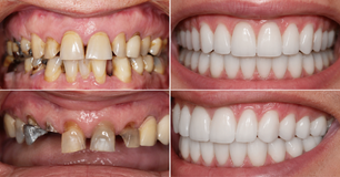 Full Mouth Rehabilitation